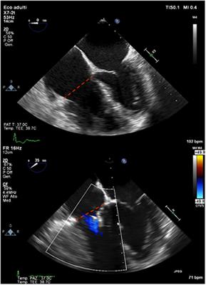 Right ventricle remodeling after transcatheter tricuspid leaflet repair in patients with functional tricuspid regurgitation: Lessons from the surgical experience